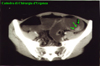 TC spirale dell'addome previa distensione retrograda del colon con soluzione acquosa di metil-cellulosa e ipotonizzazione farmacologica. 1 - formazione polipoide (freccie) di 1.5 cm sulla parete posteriore del colon discendente.