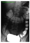 Rx clisma con doppio contrasto: immagine di minus del giunto retto-sigma; nel colon destro e nella flessura epatica immagini riferibili a formazioni polipoidi sessili e peduncolate.