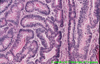 Adenocarcinoma del grosso intestino ben differenziato (E.E. 25x).