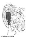 Estrazione di una bottiglia con tecnica digitale.