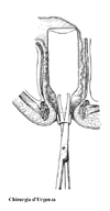 Una bottiglia con l'imboccatura rivolta verso il basso pu essere estratta introducendo una robusta pinza nell'imboccatura stessa e quindi trazionando verso il basso.