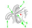 L'anatomia dell'ombelico: 1 - funicolo ombelicale con i vasi; 2 - allantoide; 3 - vena ombelicale; 4 - arterie ombelicali; 5 - ombelico; la punta di freccia rossa indica il diverticolo di Meckel.