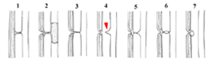 Variet anatomiche della persistenza del canale onfalo-mesenterico: 1 - cordone fibroso; 2 - fistola ombelicale completa; 3 - fistola ombelicale incompleta; 4 - diverticolo di Meckel classico (punta di freccia rossa); 5 - diverticolo di Meckel con banda fibrosa; 6 - cisti enterica; 7 - cisti enterica sotto-ombelicale.