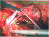 Liberazione dell'ilo renale: 1 - rene, 2 - vena renale, 3 - aorta, 4 - arteria renale, 5 - vena gonadica, 6 - milza