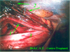 Isolamento dell'uretere e della vena gonadica al di sopra dei vasi iliaci: 1 - uretere, 2 - clips sulla vena gonadica, 3 - muscolo psoas