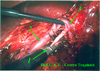 Sezione dell'arteria mediante 1 - endogia 30 vascolare; 2 - vena renale, 3 - vena gonadica gi sezionata