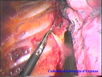 Inizia l'intervento sul lato opposto (destro); con il dissettore si sottende la pleura parietale mentre con il crochet la si disseca in direzione mediale.