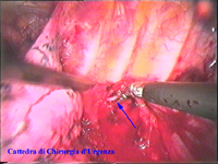 Sono stati posizionati gli strumenti nella cavit pleurica sinistra e si  aperta la pleura parietale. Inizia la dissezione della catena a livello T2-T3. La freccia blu indica la catena.