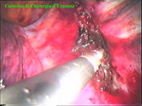 Bisogna porre molta cura nella coagulazione anche dei rami vascolari pi fini per evitare la formazione nel postoperatorio di versamenti.