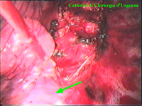 La freccia indica l'arco dell'aorta.