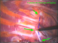 Per trasparenza sollo la pleura parietale viene identificata la catena gangliare (linea bl) per un tratto corrispondente a 2-4 metameri (freccie verdi). Con il dissettore si incide la pleura.