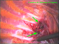 La finestra pleurica mette in evidenza in tratto di catena (freccie verdi) con un ganglio.