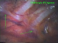 Si identifica il decorso al di sotto della pleura parietale (freccie).